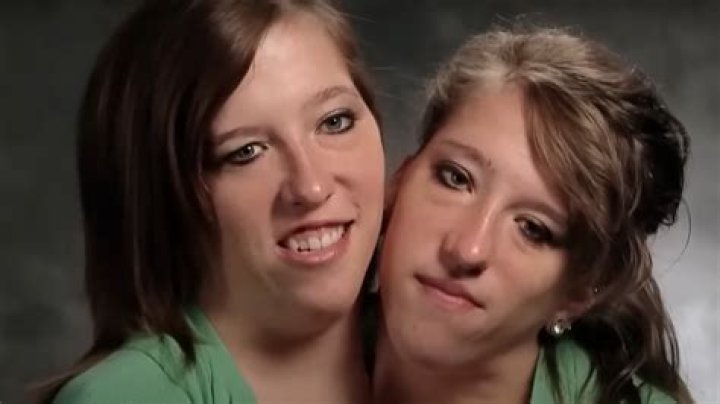 Exploring the Fascinating Lives of Abbey and Brittany Hensel: A Unique Journey of Conjoined Twins