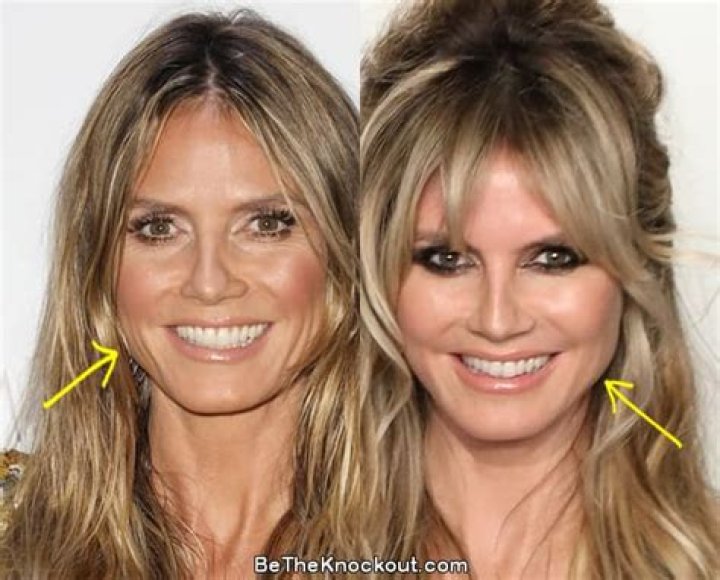 Heidi Klum Breast Implants 2024: Everything You Need to Know