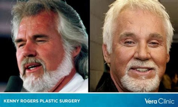 Kenny Rogers Facelift: The Journey of Transformation and Aging Gracefully