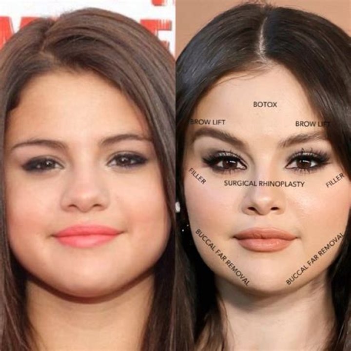 Selena Gomez: Exploring the Truth Behind Plastic Surgery Rumors
