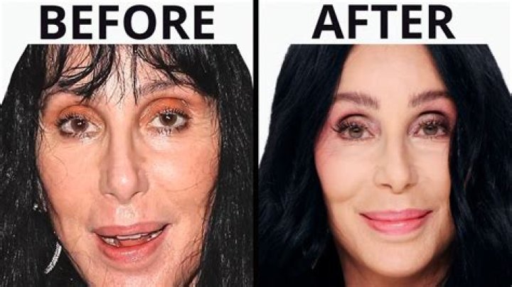 The Controversial History of Cher's Plastic Surgery