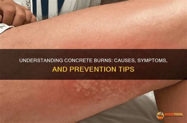 Understanding Concrete Burn Photos: A Comprehensive Guide