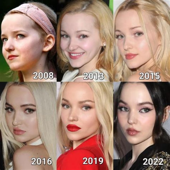 Unveiling Dove Cameron's Transformation: A Before-and-After Look at Her Plastic Surgery Journey